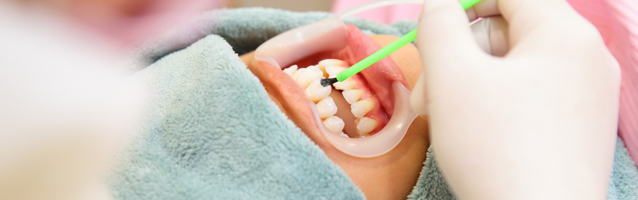 ホワイトニング・クリーニング